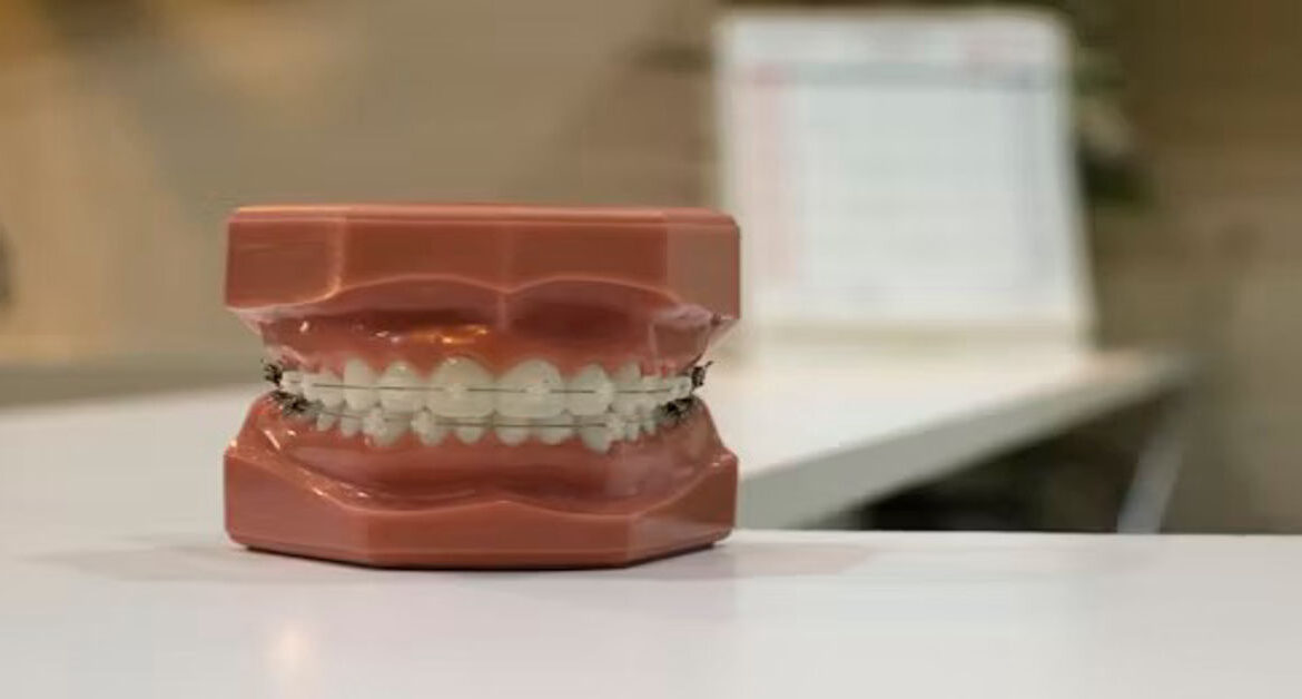 Dental Veneers for Missing Teeth
